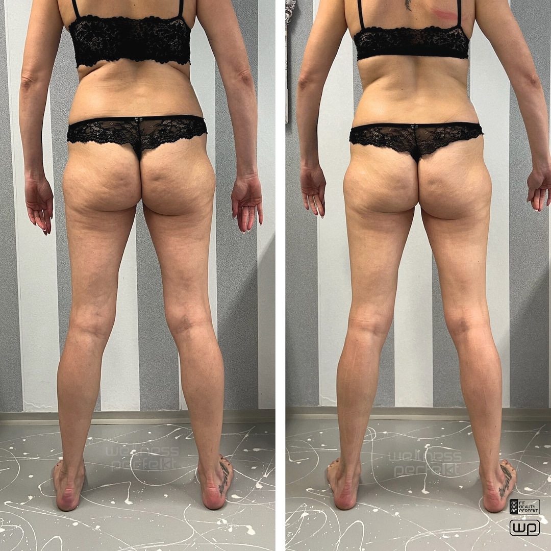 Arosha kehamähised tulemused - enne ja pärast 1