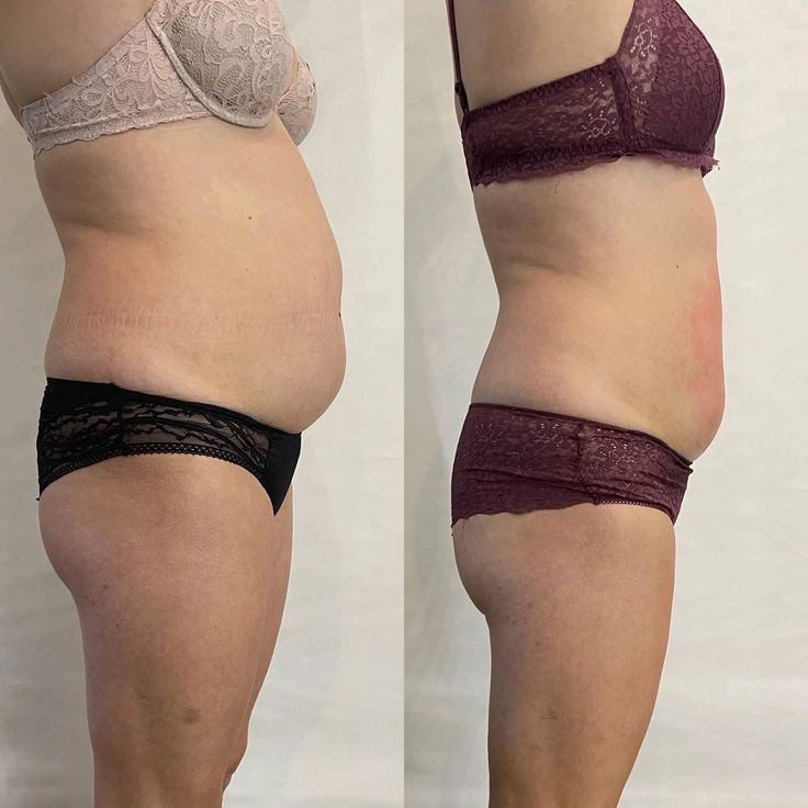 Vela Shape tulemused - enne ja pärast 1