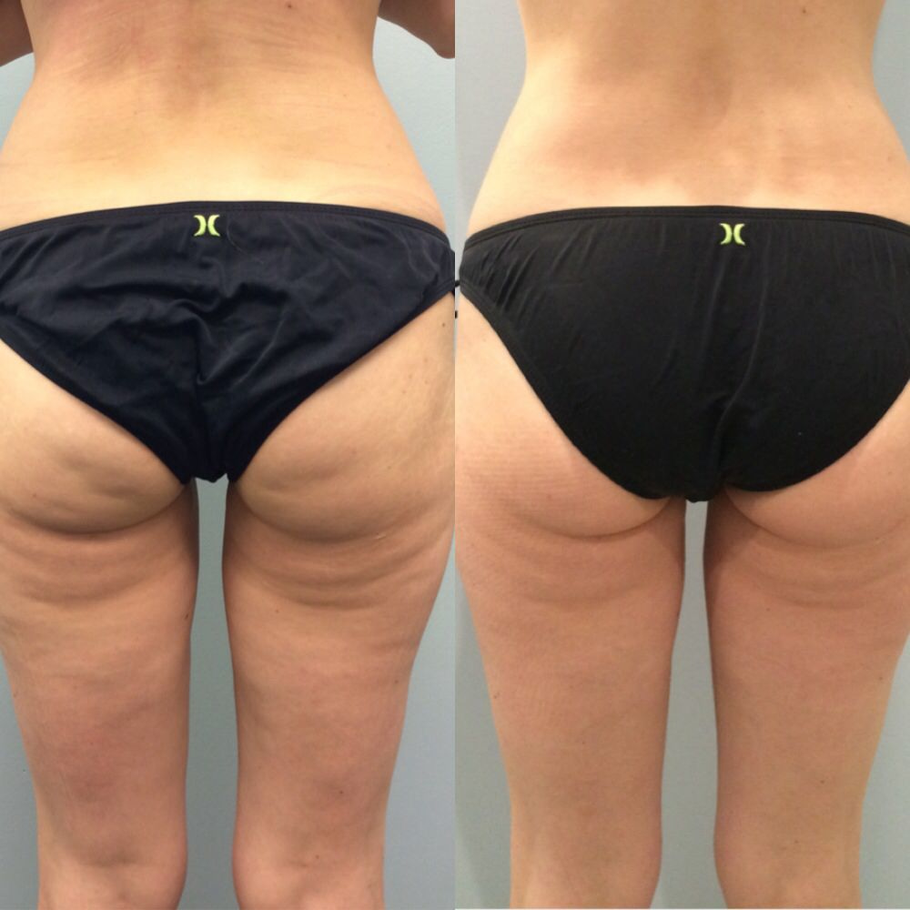 Vela Shape tulemused - enne ja pärast 2