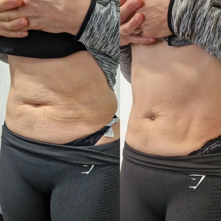 Vela Shape tulemused - enne ja pärast 3